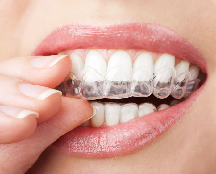 Invisalign Braces in Queens NY May Make People More Confident