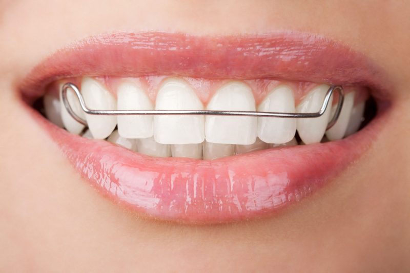 Various Options for Braces in Hinsdale