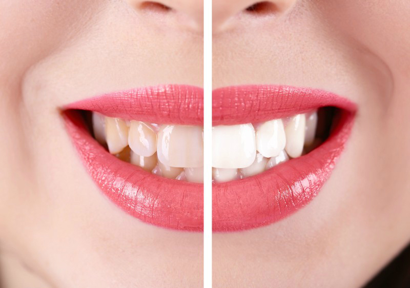 The Benefits of Teeth Whitening in Batavia