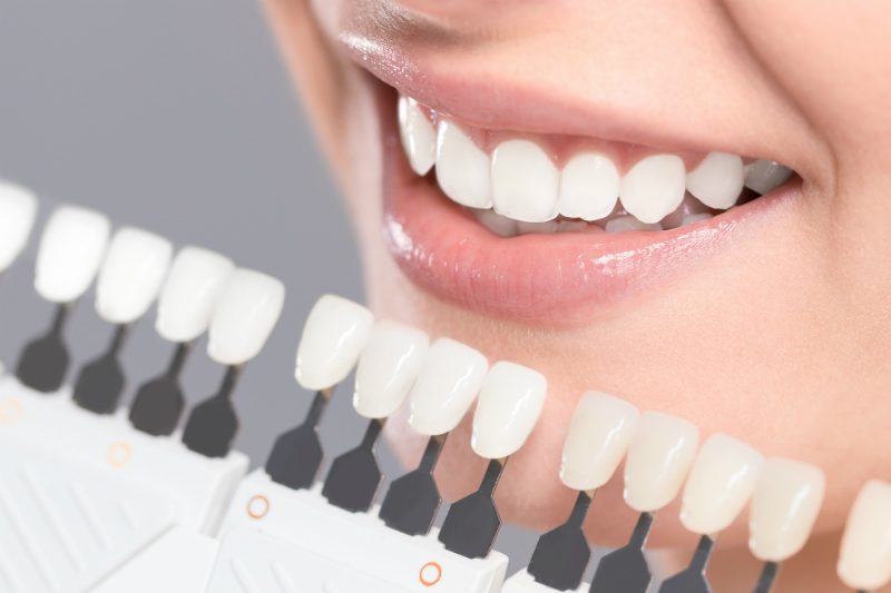 Do You Need Dental Veneers in Lincoln Park?